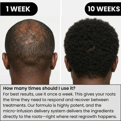 AlphaInfuse™ Hair Regrowth System
